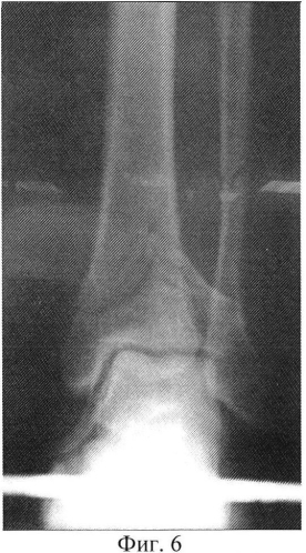 Способ временной фиксации внутрисуставных переломов дистального отдела костей голени (патент 2564080)