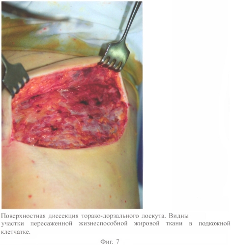 Способ реконструкции молочной железы (патент 2570762)