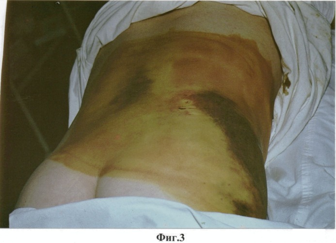 Способ диагностики типа закрытой травматической отслойки кожи (патент 2548509)