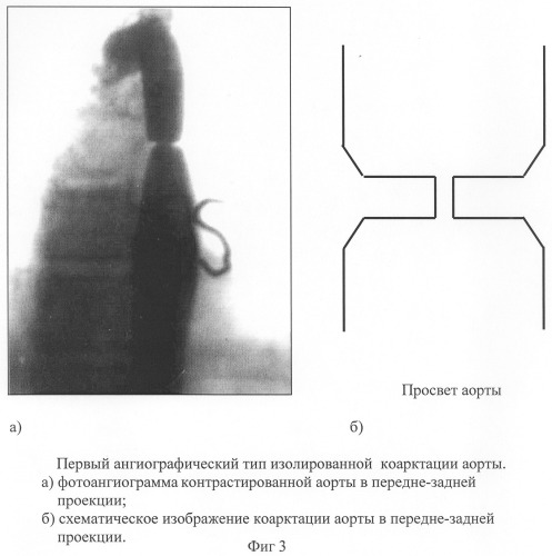 Способ диагностики изолированной коарктации аорты и способ выбора тактики ее лечения (патент 2244510)