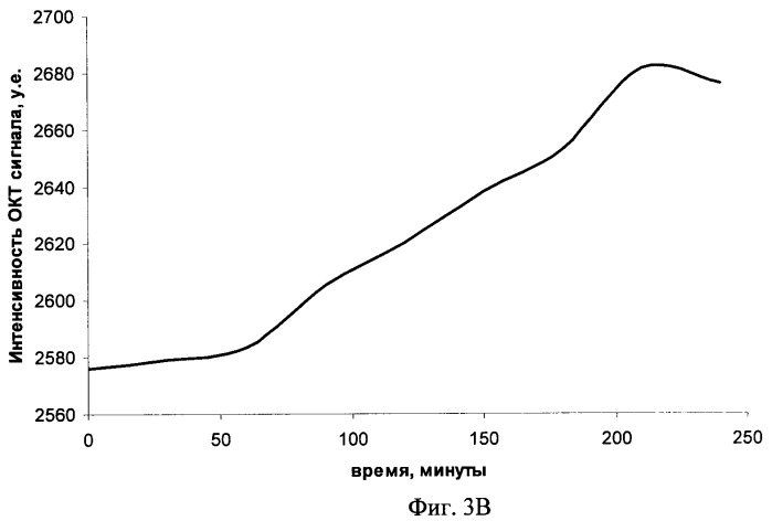 Способ лечения опухолей лазерной гипертермией (патент 2425701)