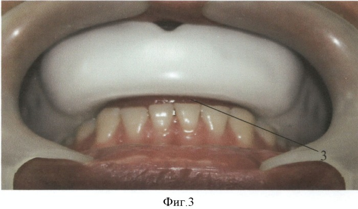 Индивидуальная спортивная зубная шина (патент 2509589)
