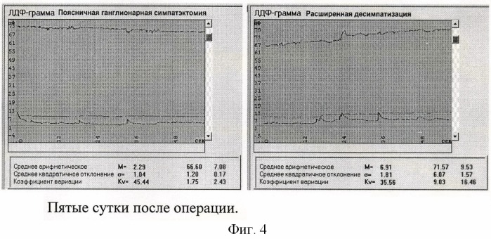 Способ комбинированной десимпатизации у больных с хронической ишемией нижних конечностей (патент 2441603)