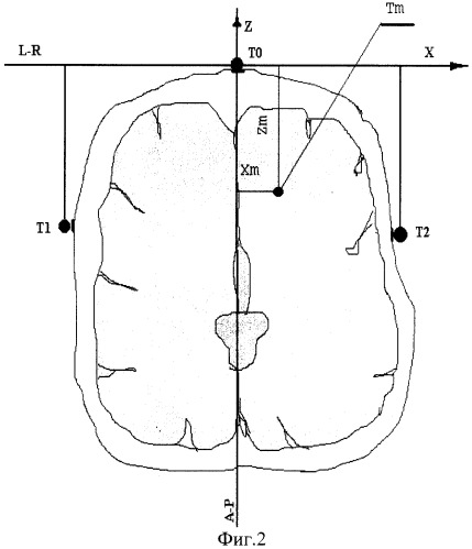 Способ наведения стереотаксического инструмента на целевую точку головного мозга (патент 2257178)