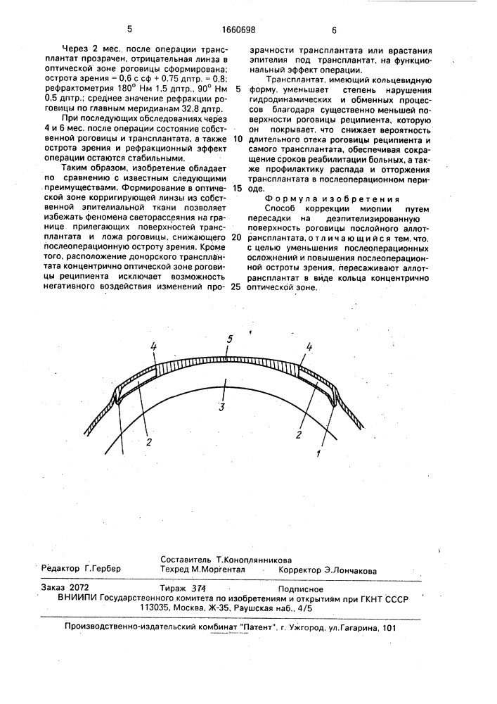 Способ коррекции миопии (патент 1660698)