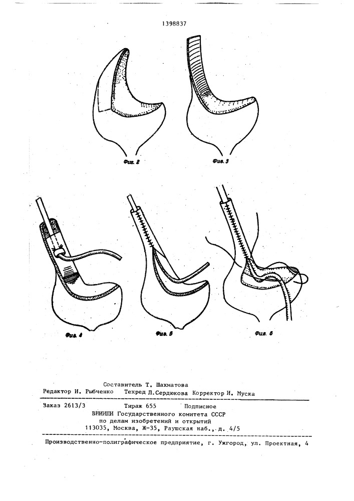 Способ лечения протяженных стриктур верхнего отдела мочеточника (патент 1398837)