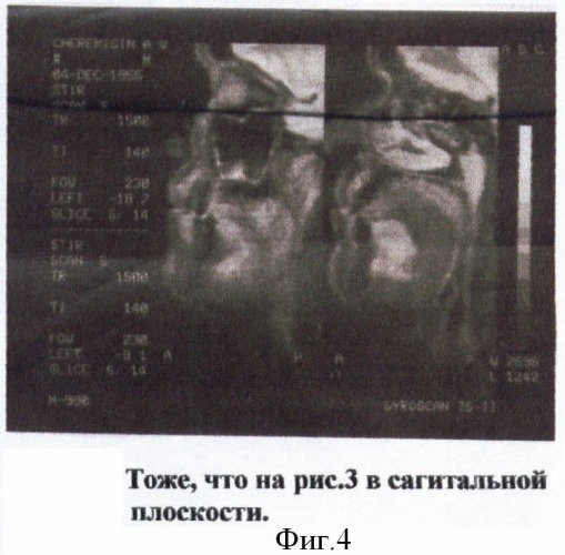 Способ функциональной реабилитации больных, перенесших операции по поводу местнораспространенных опухолей дна полости рта и нижней челюсти (патент 2371141)