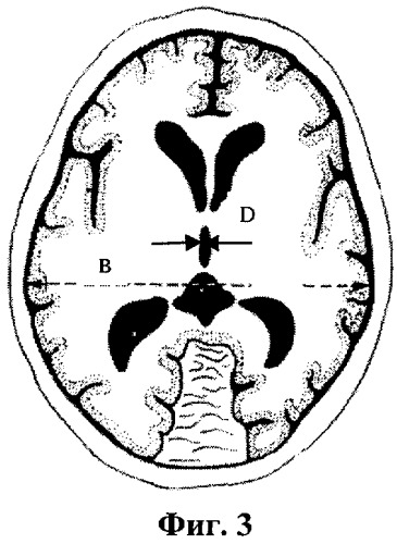 Способ прогнозирования дислокации головного мозга при его компрессии (патент 2433782)