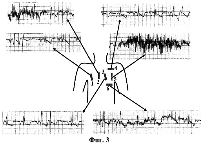 Способ определения места имплантации аппарата для подкожного мониторирования электрокардиограммы (патент 2445917)