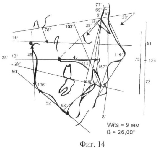 Способ объективной оценки результатов ортодонтического лечения (патент 2444292)