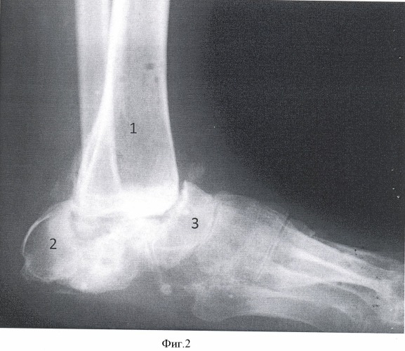 Способ реконструкции заднего отдела стопы при утрате пяточной кости (патент 2488360)