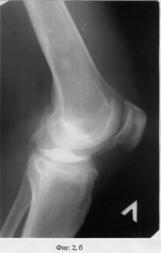 Способ лечения деформирующего артроза коленного сустава (патент 2286736)