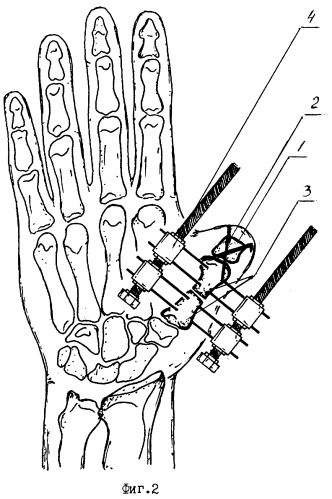 Способ дистракционного удлинения пястной кости при наличии ее культи или короткой культи основной фаланги (патент 2260394)
