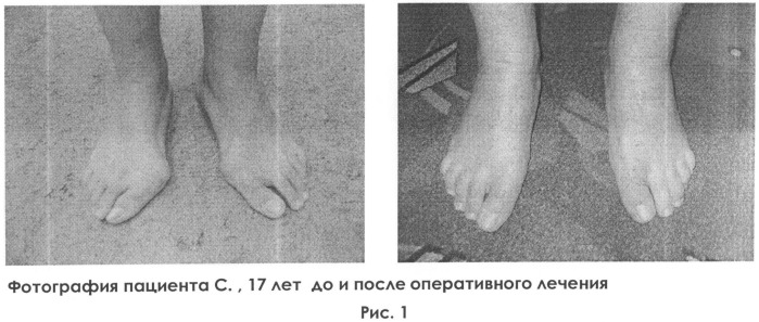 Способ лечения вальгусной деформации первого пальца стопы (патент 2509539)