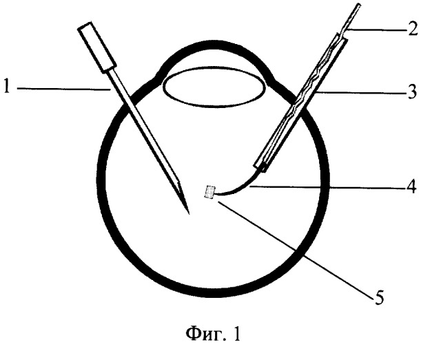 Способ проведения интраокулярной брахитерапии (патент 2325139)