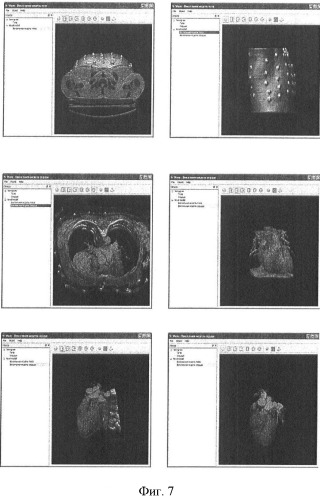 Способ неинвазивного электрофизиологического исследования сердца (патент 2417051)