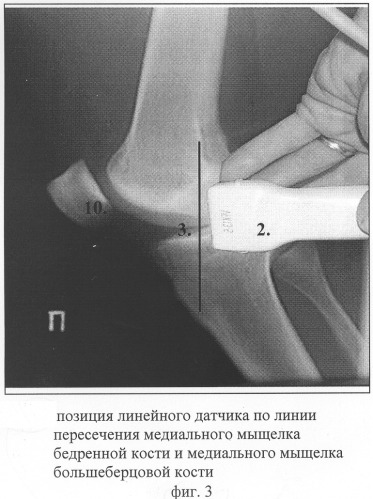 Способ комплексной ультразвуковой диагностики повреждения внутреннего мениска коленного сустава в области тела и переднего рога (патент 2305493)