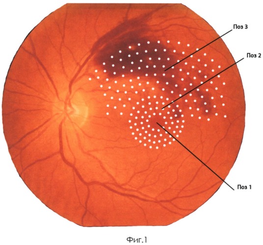 Способ комбинированного лечения ретиноваскулярного макулярного отека (патент 2527360)