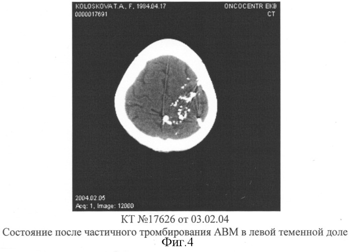 Способ эмболизации артериовенозных мальформаций головного мозга в условиях общей анестезии и управляемой гипотонии (патент 2315634)