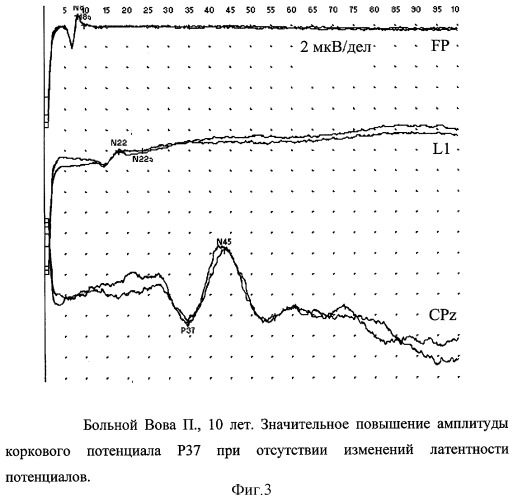 Способ оценки тяжести инфекционного поражения цнс у детей (патент 2295281)