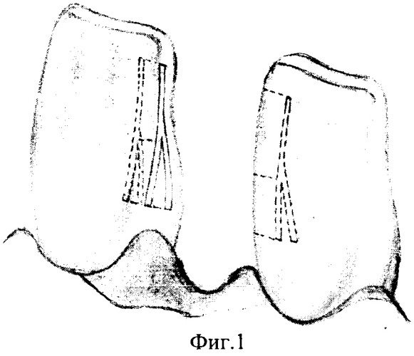 Способ изготовления адгезивного мостовидного протеза (патент 2250089)
