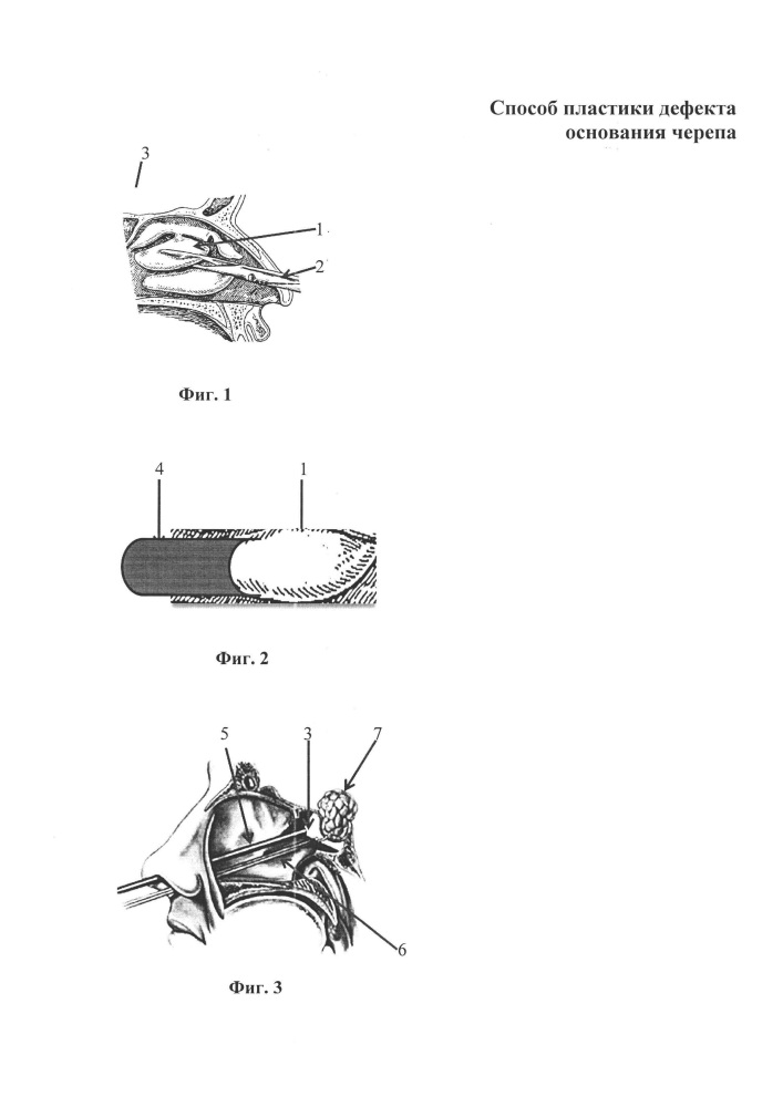Способ пластики дефекта основания черепа (патент 2606339)