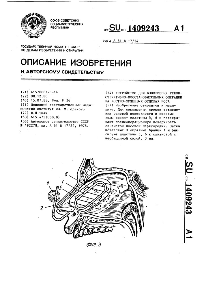 Устройство для выполнения реконструктивно-восстановительных операций на костно-хрящевых отделах носа (патент 1409243)