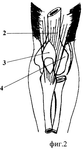 Способ удлинения сухожилия трехглавой мышцы плеча (патент 2268015)
