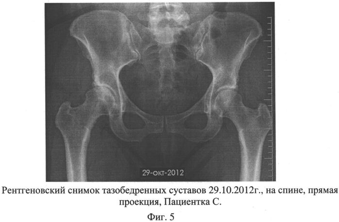 Способ лечения асептического некроза головки бедренной кости и сборы лекарственных растений для осуществления лечения (патент 2558476)