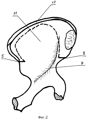 Способ одномоментного трансподвздошного удлинения нижней конечности (патент 2553509)