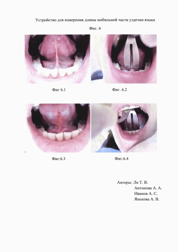 Устройство для измерения длины части уздечки языка (патент 2579279)