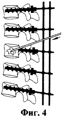 Способ вертебропластики при переломах тел позвонков (патент 2462206)