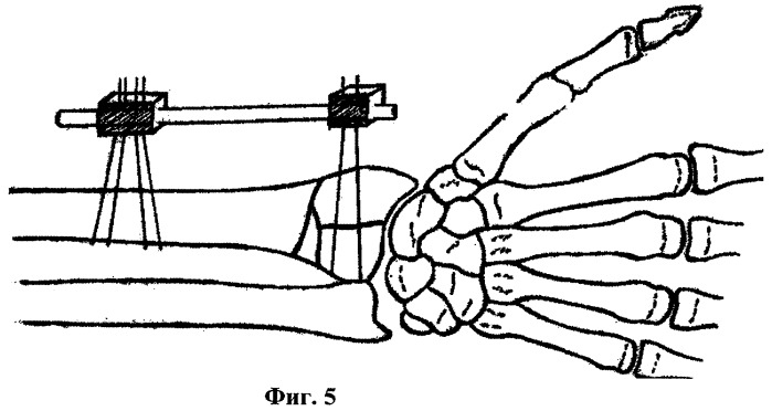Способ лечения застарелых переломов дистального отдела костей предплечья и устройство для его осуществления (патент 2266073)