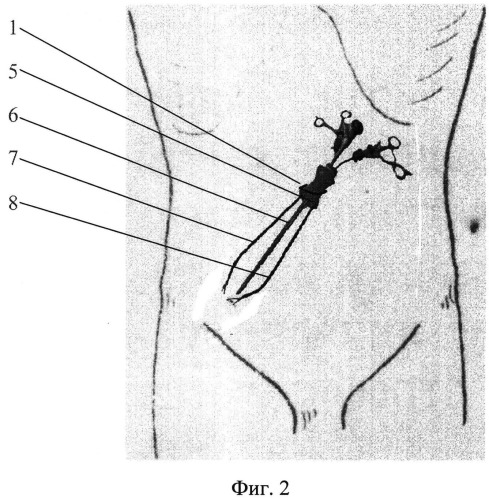 Способ видеоассистированной аппендэктомии через единый лапароскопический доступ (патент 2523631)