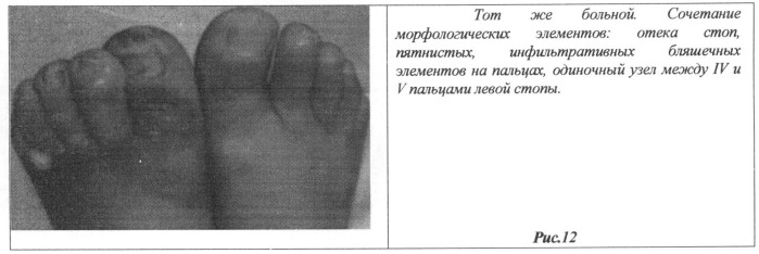 Способ прогнозирования ухудшения клинического течения идиопатической саркомы капоши, перехода хронической формы в подострую, затем в острую форму заболевания (патент 2529628)
