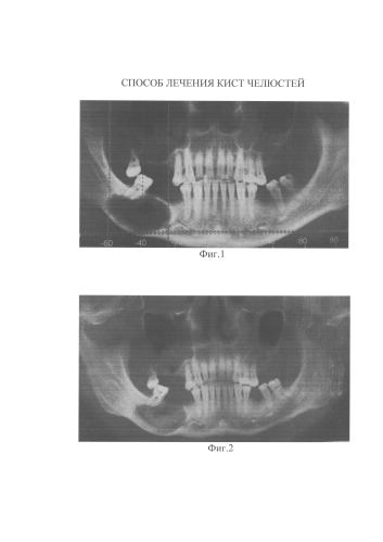 Способ лечения кист челюстей (патент 2578161)