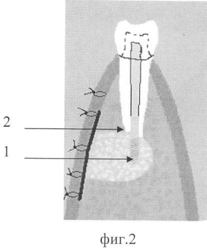 Апекс-дентальный имплантат (патент 2327433)