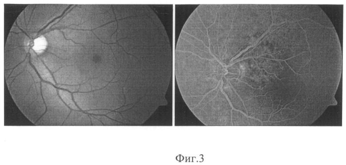 Способ определения показаний к фотодинамической терапии хронической центральной серозной хориоретинопатии (патент 2495620)