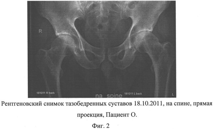 Способ лечения асептического некроза головки бедренной кости и сборы лекарственных растений для осуществления лечения (патент 2558476)