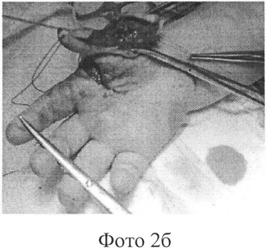 Способ реконструкции первого пальца кисти при врожденной полидактилии (патент 2577946)