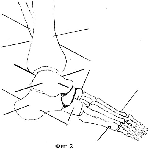 Способ оперативной коррекции деформаций стопы (патент 2412661)