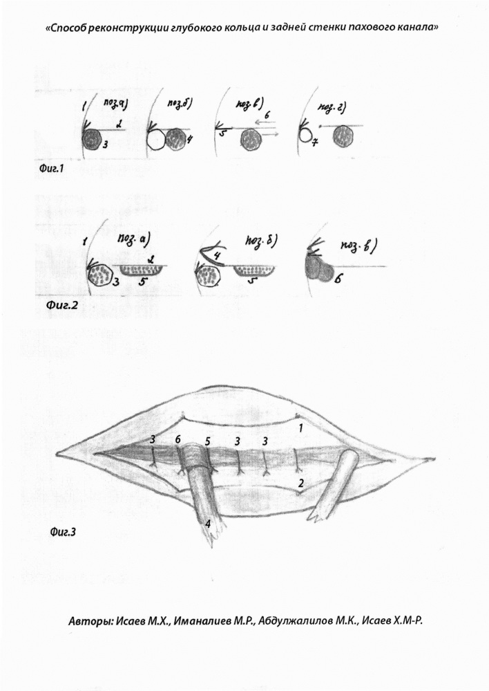 Способ реконструкции глубокого кольца и задней стенки пахового канала (патент 2630616)