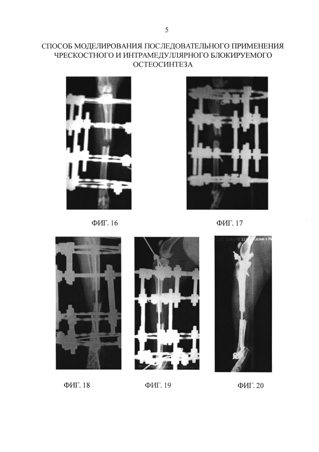 Способ моделирования последовательного применения чрескостного и интрамедуллярного блокируемого остеосинтеза (патент 2593583)