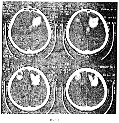 Препарат для лечения геморрагического инсульта и способ лечения геморрагического инсульта (патент 2266737)