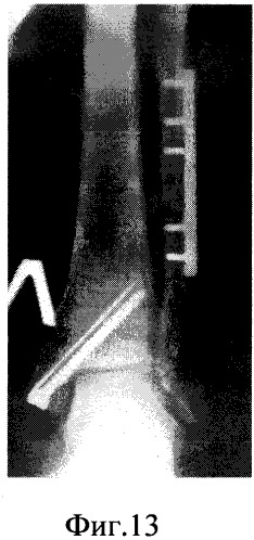 Функциональный оперативный способ лечения надсиндесмозных переломов малоберцовой кости (патент 2252721)
