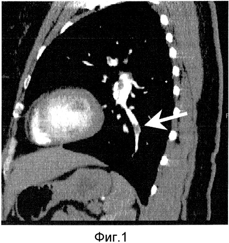Визуализация сосудистой структуры (патент 2466679)