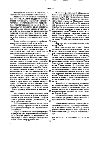 Способ лечения хронического периодонтита многокорневых зубов (патент 2000742)