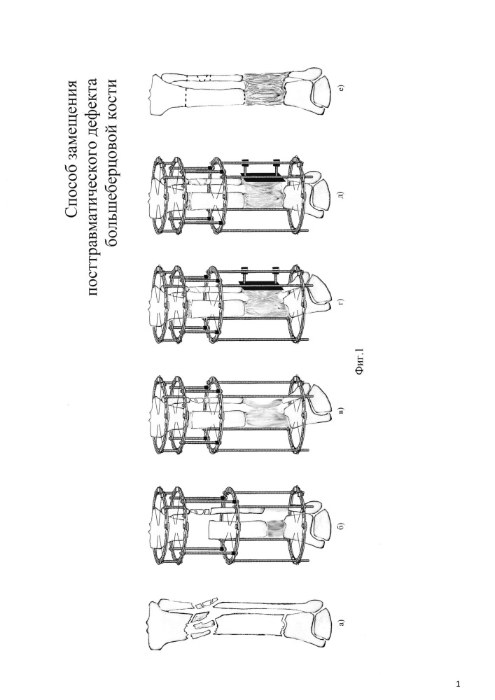 Способ замещения посттравматического дефекта большеберцовой кости (патент 2626146)