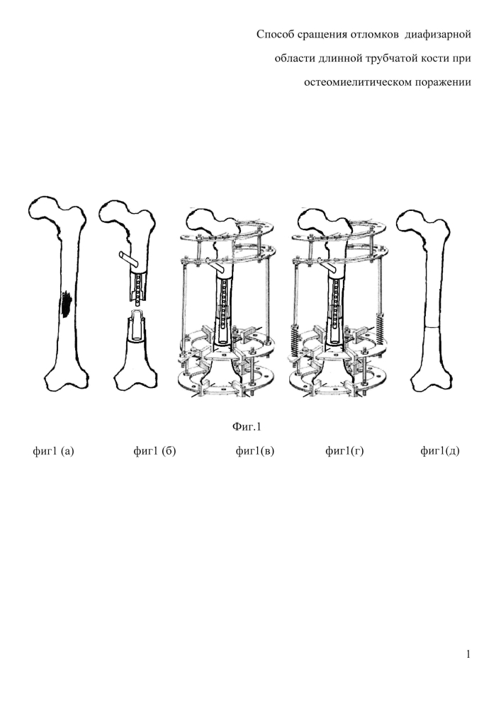 Способ сращения отломков диафизарной области длинной трубчатой кости при остеомиелитическом поражении (патент 2604769)