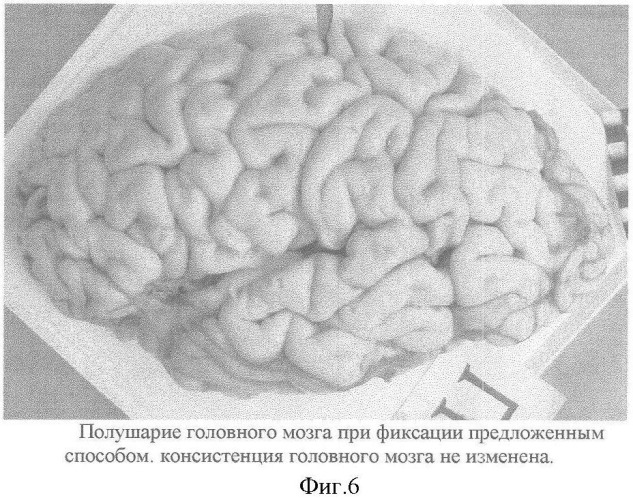 Способ фиксации головного мозга человека без вскрытия полости черепа (патент 2360612)